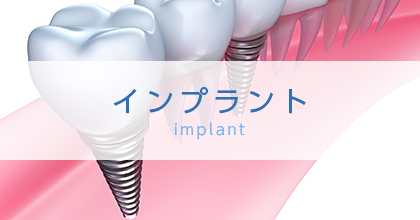 インプラント implant